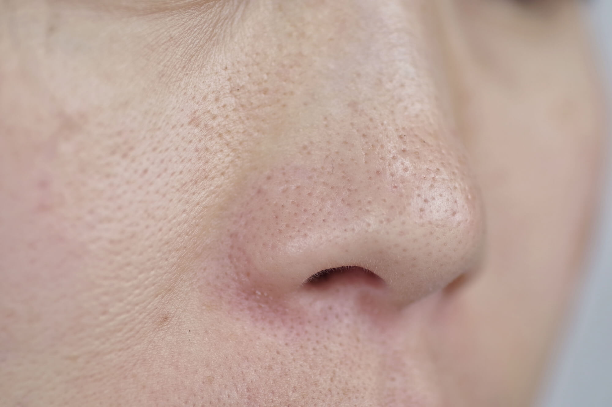 メラニン毛穴のいちご鼻